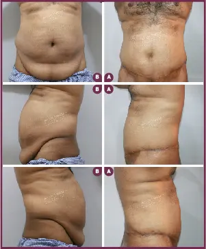Male Extended Tummy Tuck Surgery Before and After Images