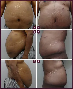 Male Medium Tummy Tuck Surgery Before and After Images