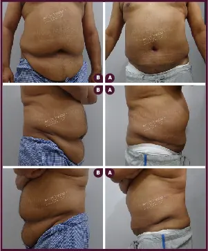 Male Medium Tummy Tuck Surgery Before and After photos