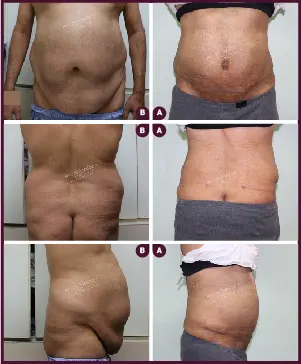 Male Medium Tummy Tuck Surgery Before and After cost