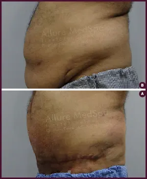 Male Medium Tummy Tuck Surgery Before and After cost