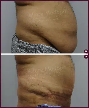 Male Medium Tummy Tuck Surgery Before and After mumbai