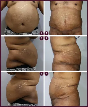 Male large Tummy Tuck Before and After