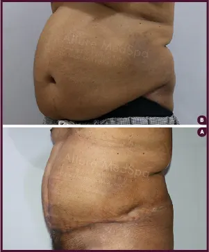 Male large Tummy Tuck Before and After images