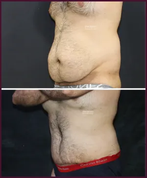 before and after photos of a tummy tuck surgery of successfully lower abdomen fat removed