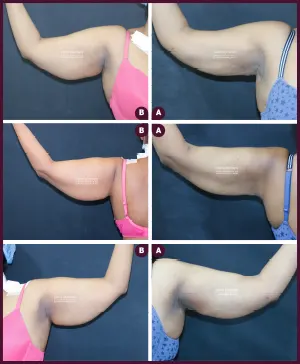 Arm liposuction surgery in mumbai