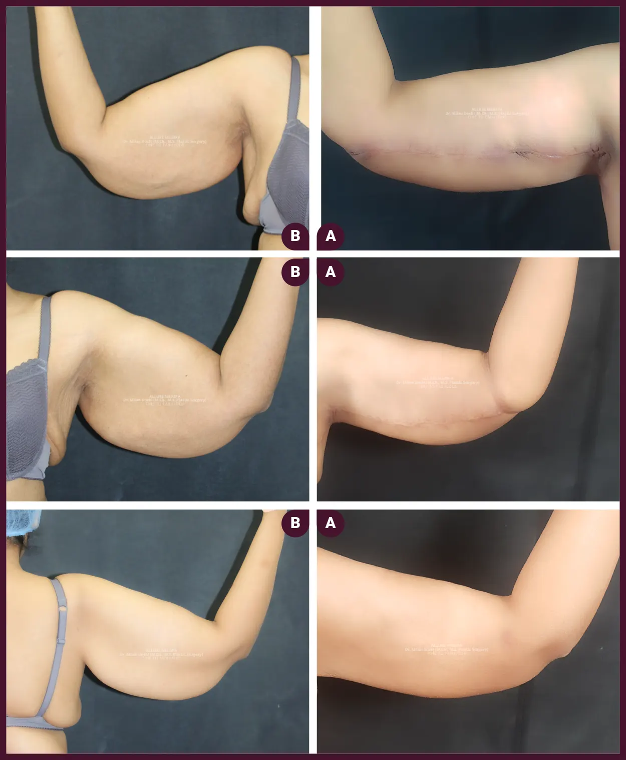 Female Large Arm BRACHY PLASTY cost Done by Dr. Milan Doshi In Mumbai