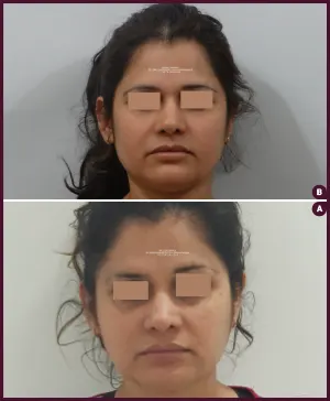 Incredible results seen in before and after picture of Cheiloplasty surgery in Mumbai