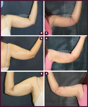 Female medium Arm Liposuction surgery