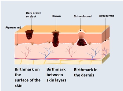 Explanation on what are birthmarks through this image file in mumbai