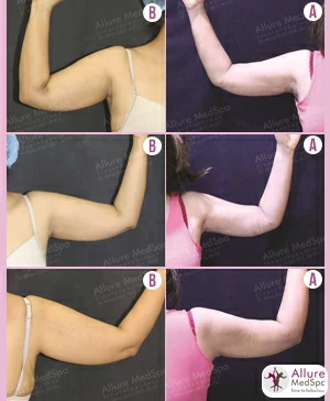 Arm Liposuction in mumbai