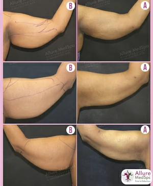 Arm Liposuction in mumbai