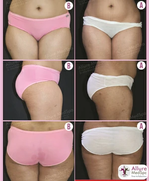 back fat female liposuction surgery cost