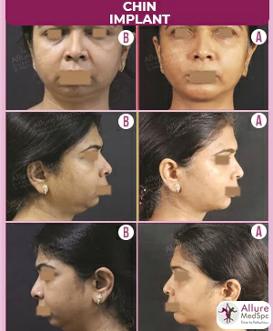 CHIN IMPLNT & DOUBLE CHIN LIPOSUCTION SURGERY RESULT IMAGES & COST IN ANDHERI (WEST),MUMBAI, INDIA