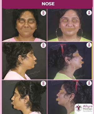 FEMALE DOUBLE CHIN LASER LIPOSUCTION SURGERY RESULT IMAGES & COST IN ANDHERI (WEST),MUMBAI, INDIA