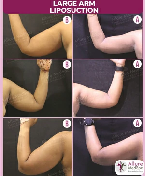 FEMALE LARGE ARM : VASER LIPOSUCTION SURGERY SCARLESS RESULT/ COST IN ANDHERI (WEST),MUMBAI, INDIA