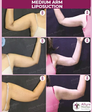 FEMALE MEDIUM ARM: RESULT IMAGES/ VASER LIPOSUCTION SURGERY COST IN ANDHERI (WEST),MUMBAI, INDIA
