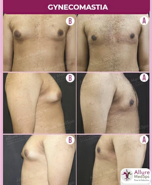 Male Chest Correction / Gynecomastia Surgery in Andheri, Mumbai, India