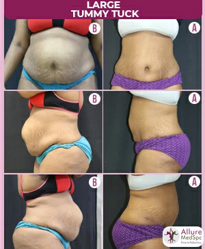 before and after photos of tummy tuck surgery resulting in a flatter and more toned appearance