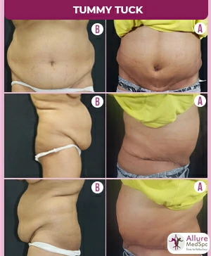 EXTENDED TUMMY TUCK SURGERY RESULT IMAGES/ LIPOABDOMINOPLASTY COST IN ANDHERI (WEST),MUMBAI, INDIA