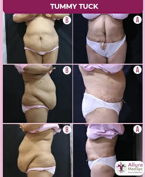 EXTENDED TUMMY TUCK SURGERY RESULT IMAGES/ LIPOABDOMINOPLASTY COST IN ANDHERI (WEST),MUMBAI, INDIA