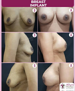 natural looking result with breast implant surgery at allure medspa, cosmetic surgery clinic in mumbai