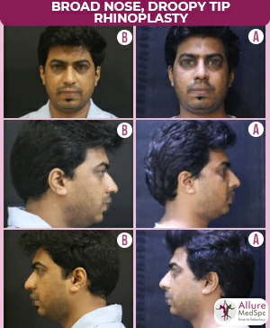 droopy tip rhinoplasty in mumbai