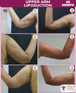 Upper arm Liposuction surgery in Mumbai