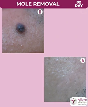 Mole Removal Treatment dermatologist in Mumbai, India