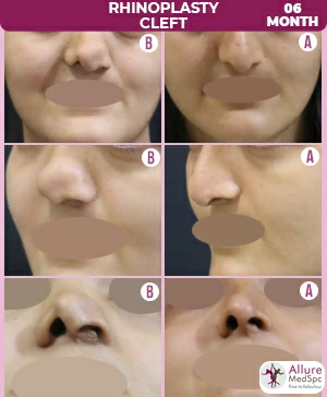 Cleft nose reshaping surgery result image & cost in Andheri (west), Mumbai, India