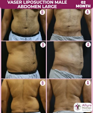 Male abdomen vaser megaliposuction surgery result image/ cost in Andheri (west), Mumbai, India
