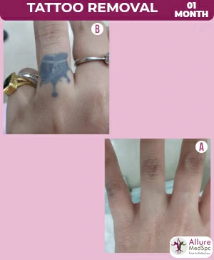 Permanent Laser Tattoo Removal Treatment Cost, Andheri West, Mumbai, India