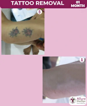 Best Skin Doctor for Laser Tattoo Removal in Delhi  DermaWorldtitle   DermaWorld Skin Clinic