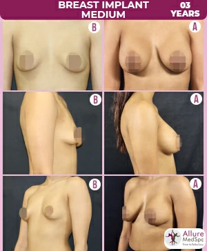 stunning before and after photos of breast augmentation surgery at cosmetic surgery clinic in mumbai