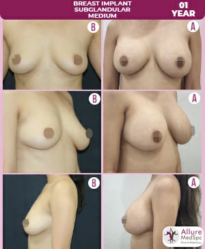 Achieve your desired look with breast enhancement procedure at allure medspa, dr milan doshi