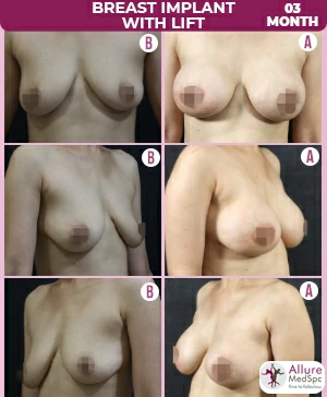 Compare the changes in breast size and shape with before and after images of breast augmentation