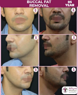 Buccal fat Removal surgery Before and after by Dr Milan Doshi at Allure MedSpa, Cosmetic Surgery Clinic in Mumbai
