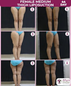 Female Medium Thigh Liposuction surgery before and after
