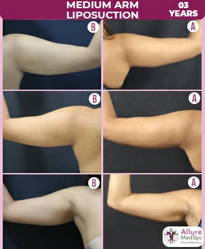 Medium_Arm_Liposuction