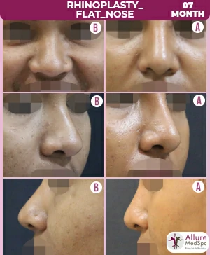 Rhinoplasty_Flat_Nose~1 female nose