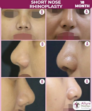 Female Short Nose Rhinoplasty surgery Before and after