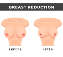 breast-reduction before and After images