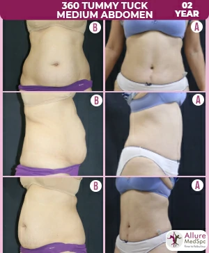 before and after image shows the dramatic change from tummy tuck surgery in andheri mumbai