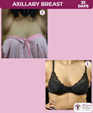 Breast augmentation surgery success stories and stunning before and after results