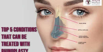 Top 5 Condition treated with Rhinoplasty