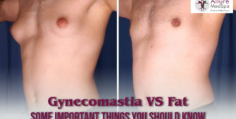 Gynecomastia vs Chest Fat