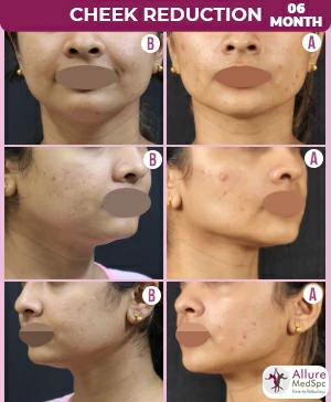 Before and after images of cheek reduction surgery done in mumbai at allure medspa