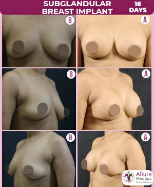 Amazing transformation Breast implant surgery before and after