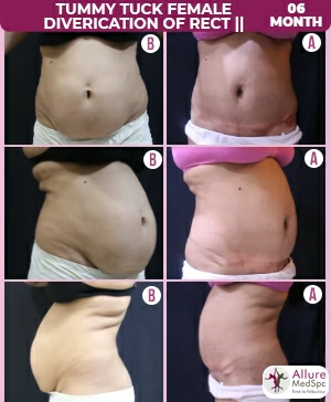 before and after image shows the significant difference achieved from tummy tuck surgery
