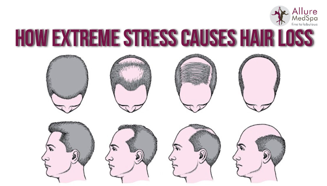Visit to Learn How Stress Can Cause Hair Loss | Allure MedSpa